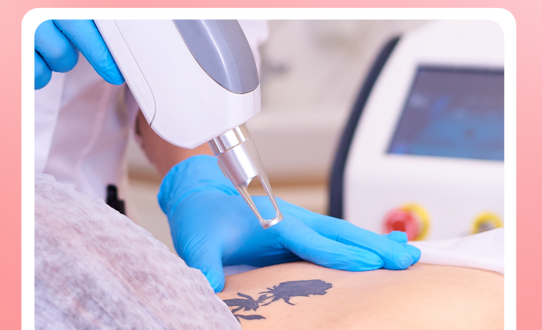 Transform Your Skin with Pico Laser Tattoo Removal