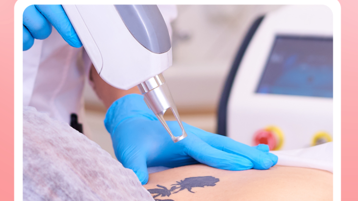 Transform Your Skin with Pico Laser Tattoo Removal