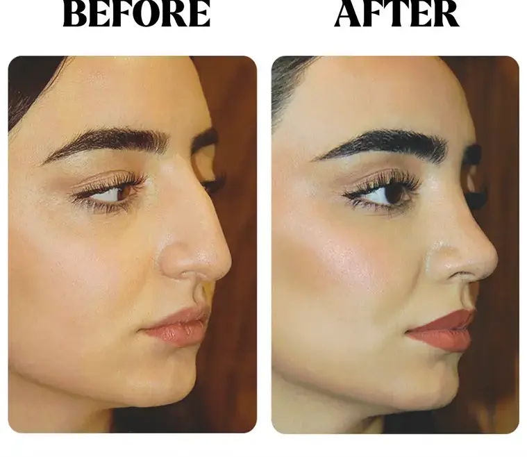 Preparing for Rhinoplasty Surgery: A Guide to Your Journey with Dr. Chobanian