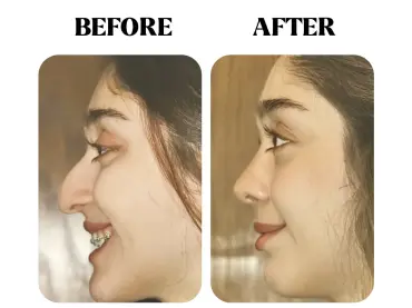 Scareless Rhinoplasty: Refine Your Nose Without Visible Scars